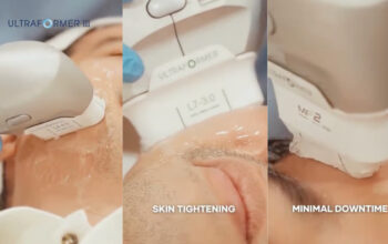 MOLD Manila Shares the Spotlight on Ultraformer Deep Dive: The Ultrasound Lift Redefining Non-Surgical Beauty in Quezon City